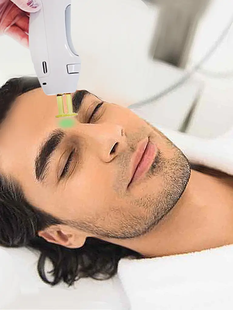 facial laser hair removal for men
