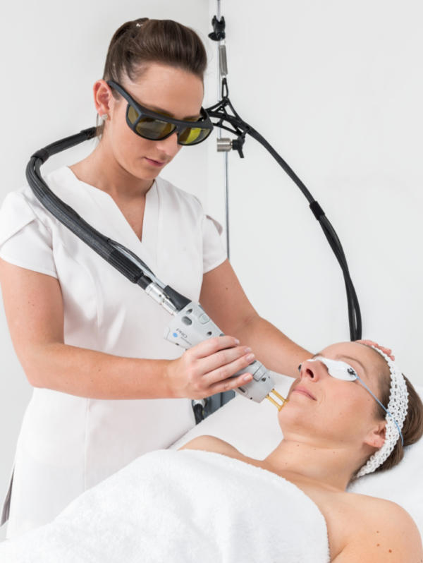 chin laser hair removal for women