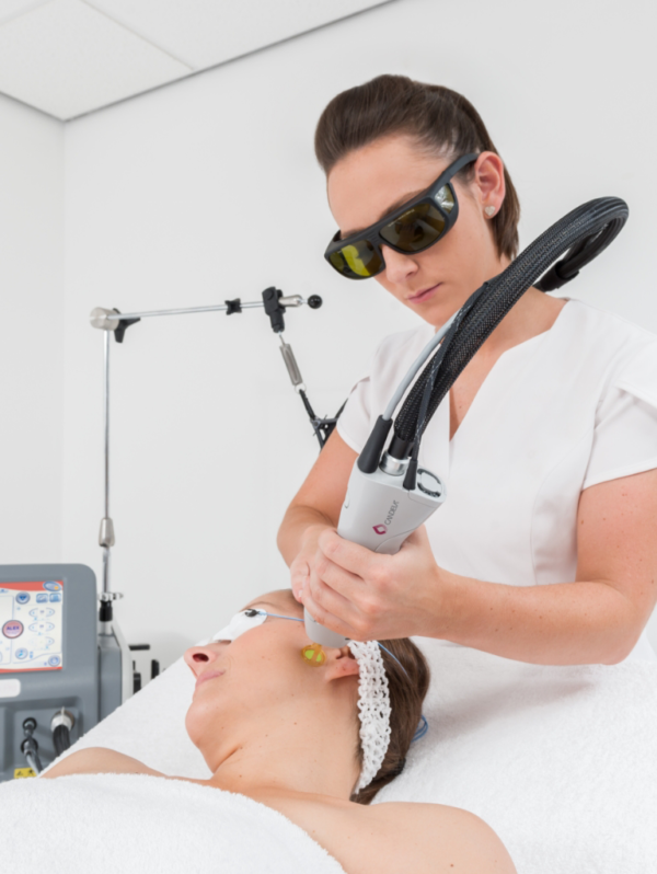 side of face laser hair removal