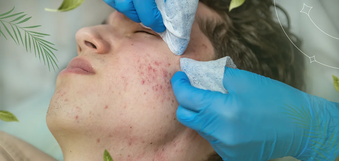 Acne Treatment Tips for the Best Results