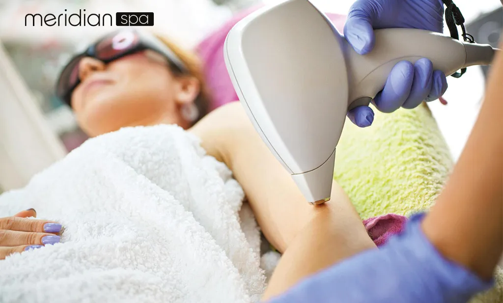 This picture illustrating the process of laser hair removal, showing a laser beam targeting hair follicles on the skin's surface.
