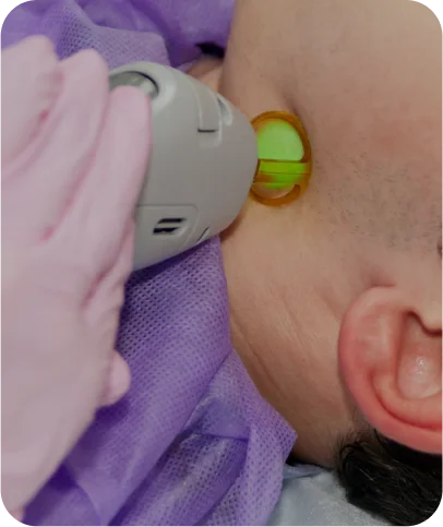 Cheek Laser Hair Removal - Men