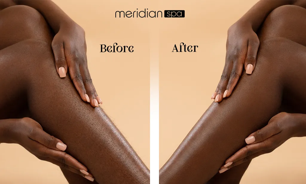 Laser Hair Removal Of Black Skin Before And After