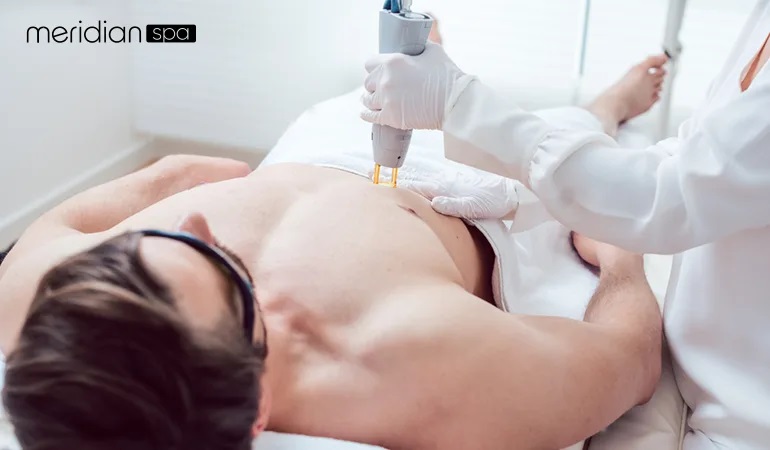 laser hair removal treatment