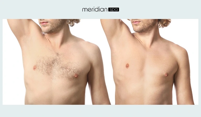 What to expect from laser hair removal